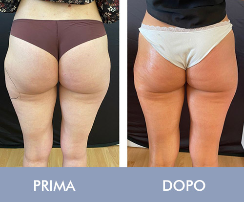 Prima e dopo criolipolisi fianchi